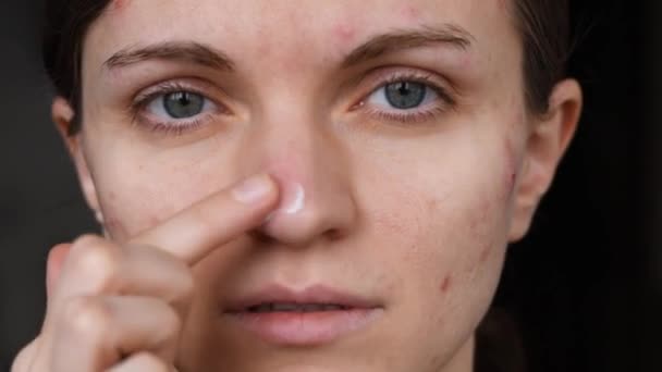 Schönes Mädchen Mit Nicht Glatter Haut Schmiert Rote Pickel Gesicht — Stockvideo