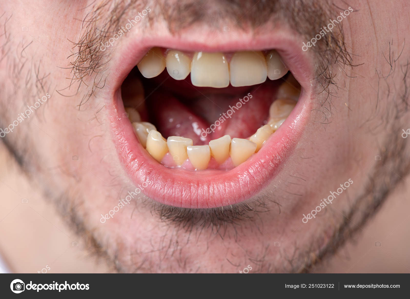 bristles teeth