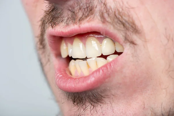 Um homem com cerdas e uma boca aberta com dentes irregulares — Fotografia de Stock