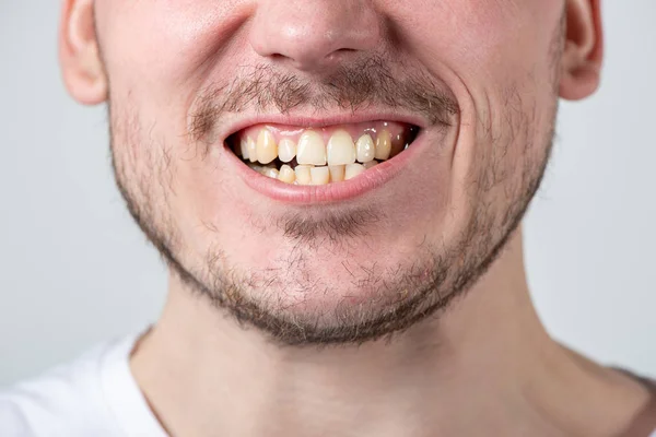 Un hombre con cerdas y una boca abierta con dientes irregulares —  Fotos de Stock