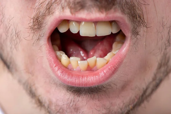 A man with bristles and an open mouth with uneven teeth