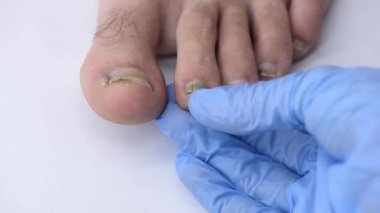 Doktorun elinin, bir adamın ayağından çıkan deforme olmuş kirli tırnağı incelerken yakın plan fotoğrafı.