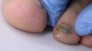 Doktorun elinin, bir adamın ayağından çıkan deforme olmuş kirli tırnağı incelerken yakın plan fotoğrafı.