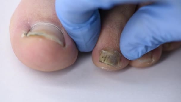 Close Doctor Hand Examining Deformed Dirty Nail Comes Mans Foot — Stock Video