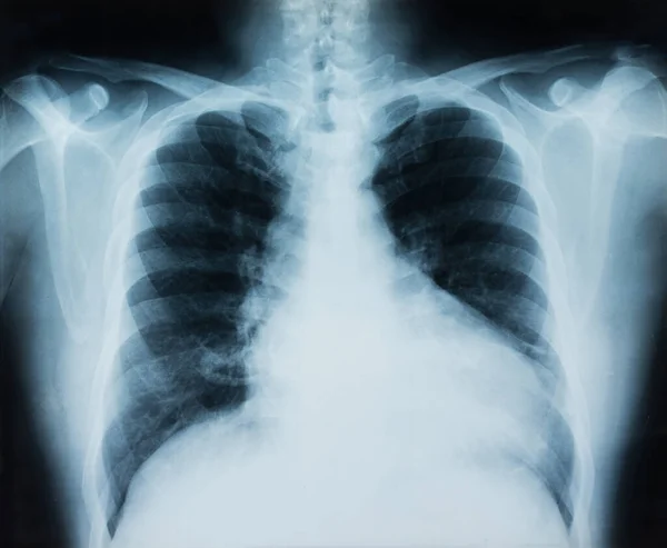 X-ray borst — Stockfoto