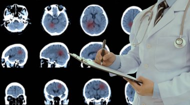 Doktor teşhisi, MRI taraması beyin tomografisi intraserebral kanama, tümör..