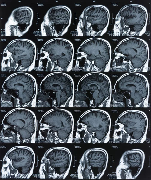 Imagem Raio Cérebro Por Ressonância Magnética Tomografia Computadorizada Para Diagnóstico — Fotografia de Stock
