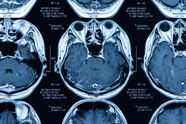 Magnetická Rezonance Mri Scan Mozku — Stock fotografie