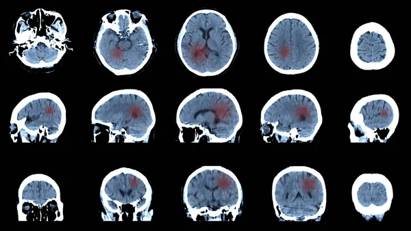 Rezonans Magnetyczny Mózgu Tomografia Mózgowo Żuchwowa Wieńcowa Obraz Poprzeczny Celu — Zdjęcie stockowe