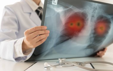 Akciğer kanseri. Doktor radyoloji, röntgen görüntülerini kontrol edin. Klinikteki hastanın akciğer tümöründe sorun var..