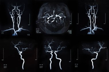 Beyin felci ve serebrovasküler hastalığın MR 'ı. Beyin x-ray görüntüsü.