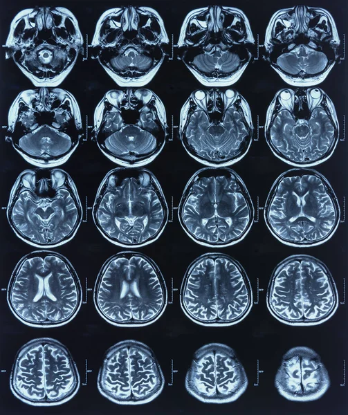 Рентгеновское Изображение Мозга Пациента Помощью Компьютерной Томографии Мрт Медицинской Диагностики — стоковое фото