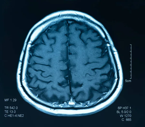 Manyetik Rezonans Görüntüsü Beynin Mri Taraması — Stok fotoğraf