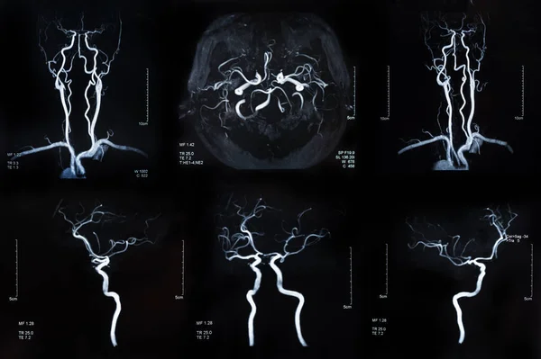 脑卒中和脑血管疾病的Mri表现 脑部X光影像 — 图库照片