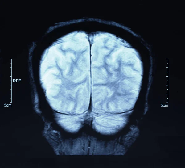 Magnetická Rezonance Mri Scan Mozku — Stock fotografie