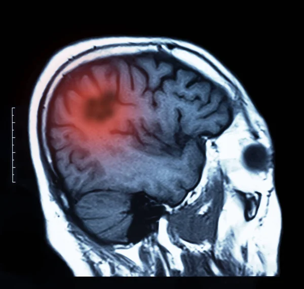 Cancer Cerveau Irm Scanne Image Radiographique Cerveau Patient — Photo