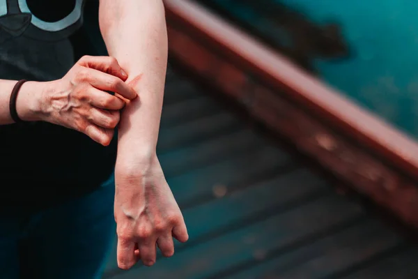 Nahaufnahme Der Hände Einer Jungen Frau Mit Einer Kleinen Wunde — Stockfoto