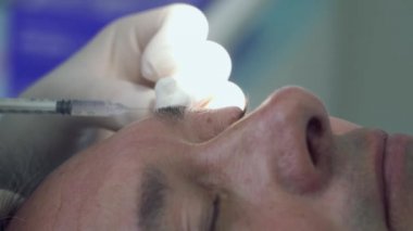 Dermatolog yanan köstebek hastanın göz kapağı, lazer ile