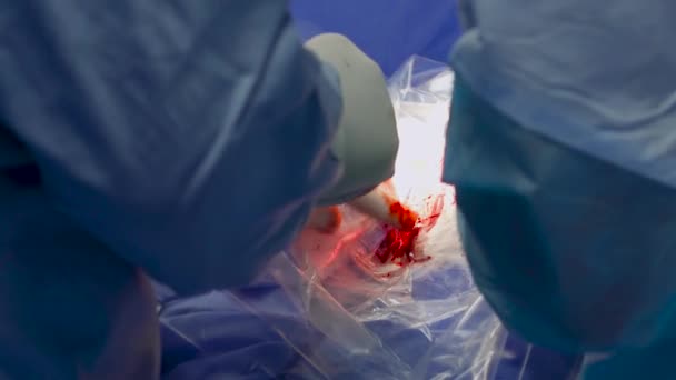 Операция хирургов, процесс в деталях — стоковое видео