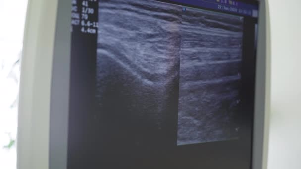 Close-up screen of joint ultrasound. Medical equipment working in hospital. Medicine, bones examination, rheumatology, health care concept. — Stock Video