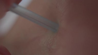 Vücuda eklenmiş aşırı yakın çekim akupunktur iğnesi. Tanımlanamayan doktor, geleneksel Çin tıbbı kullanarak genç beyaz hastayı iyileştiriyor..