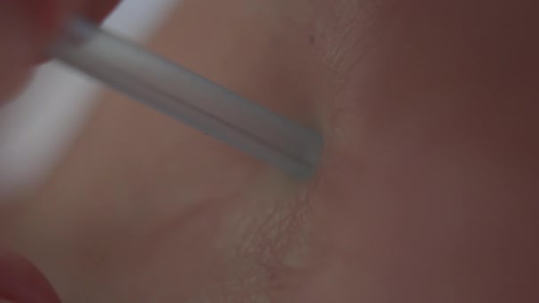 Extremo close-up da agulha de acupuntura inserida no corpo. Médico irreconhecível cura jovem paciente caucasiano usando a medicina tradicional chinesa . — Vídeo de Stock