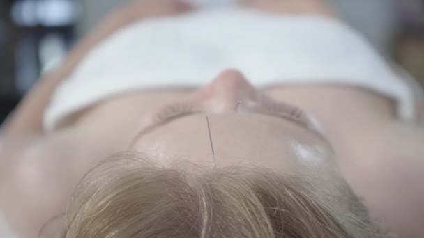 Közelkép a női fejbőrről tűvel a fején. Akupunktúrás terápián lévő fiatal, fehér nő feje fölött lövöldözni. Hagyományos kínai orvoslás koncepciója. — Stock videók