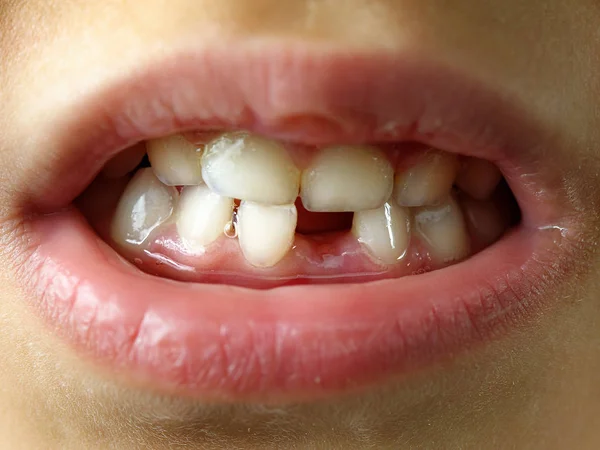 Ontbrekende tand glimlach Kid of kinderen mond close-up of macro — Stockfoto