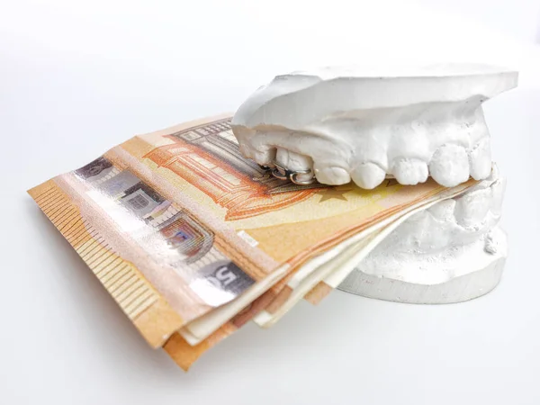 Closeup Miúdo Ortodôntico Impressão Dentária Giz Modelo Mordendo Euro Dinheiro — Fotografia de Stock