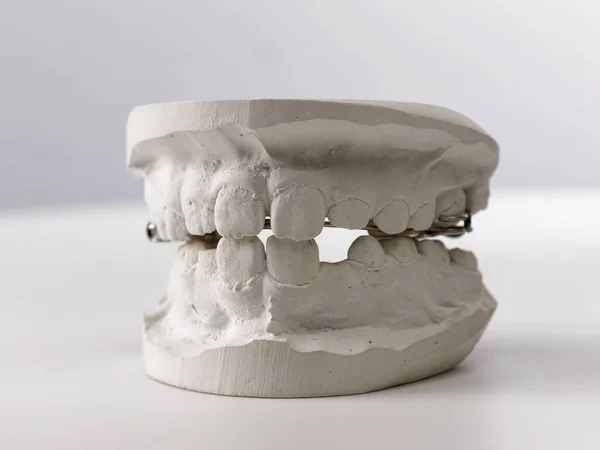 Molde Dental Gris Dientes Prótesis Modelo Encías Humanas Arcilla — Foto de Stock
