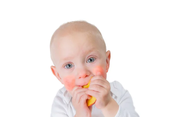 Concept d'allergie alimentaire - bébé avec dermatite sur les joues — Photo