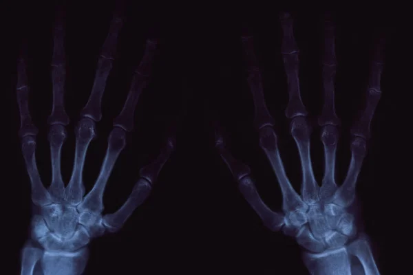 X-ray of hands with arthritis on black background. — Stock Photo, Image