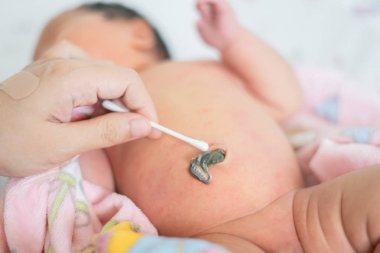 Bebek göbek kordonu kadar yok etmek için alkolle ıslatılmış pamuk bez kullanarak doktor