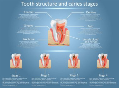 Human tooth structure vector diagram and caries stages. Dental anatomy and tooth decay or cavities development concept. Training medical anatomical poster. clipart