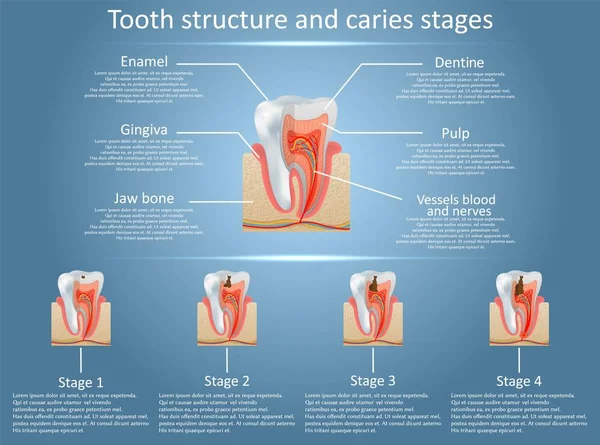 İnsan diş yapısı vektör diyagramı ve çürük aşamaları. Diş anatomisi ve diş çürümesi veya boşluklar geliştirme kavramı. Eğitim tıbbi anatomik poster.