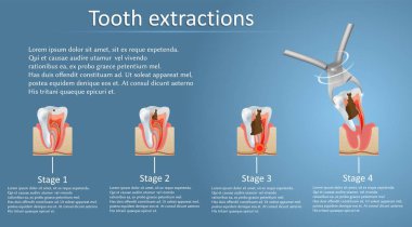Tooth extraction concept vector poster banner template clipart