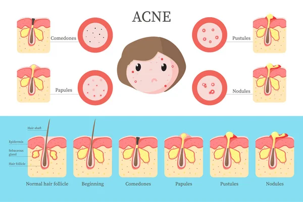 Types d'acné et infographie de formation, illustration plate vectorielle — Image vectorielle