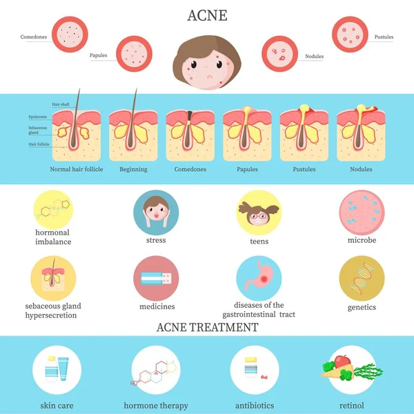 Tipos de acné, causas e infografías de tratamiento, ilustración plana vectorial — Vector de stock