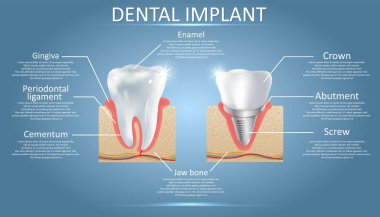 İnsan diş ve diş implantı, vektör eğitim posteri