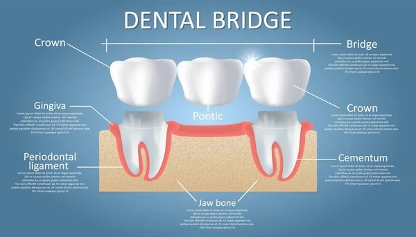 Dental Bridge koncept vektor pedagogisk affisch, diagram — Stock vektor