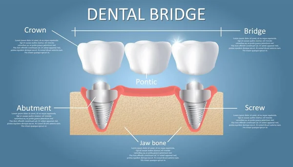 Puente dental concepto vector educativo cartel, diagrama — Vector de stock