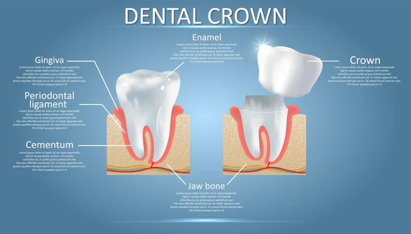 Diente humano y corona dental, vector educativo cartel — Vector de stock