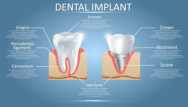 Diente humano e implante dental, vector educativo cartel — Archivo Imágenes Vectoriales