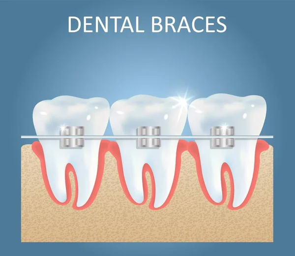 Modelo de design de cartaz médico vetorial de aparelhos dentários —  Vetores de Stock