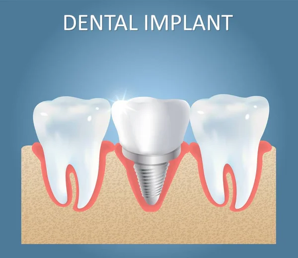 Plantilla de diseño de póster médico de vector de implante dental — Archivo Imágenes Vectoriales