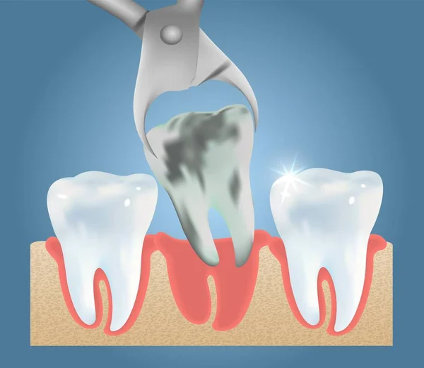 Plantilla de diseño de póster médico vector extracción de dientes — Vector de stock