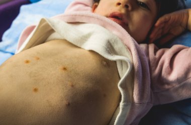 Tavuk Pox'u babys karın üzerinde ilk noktalar