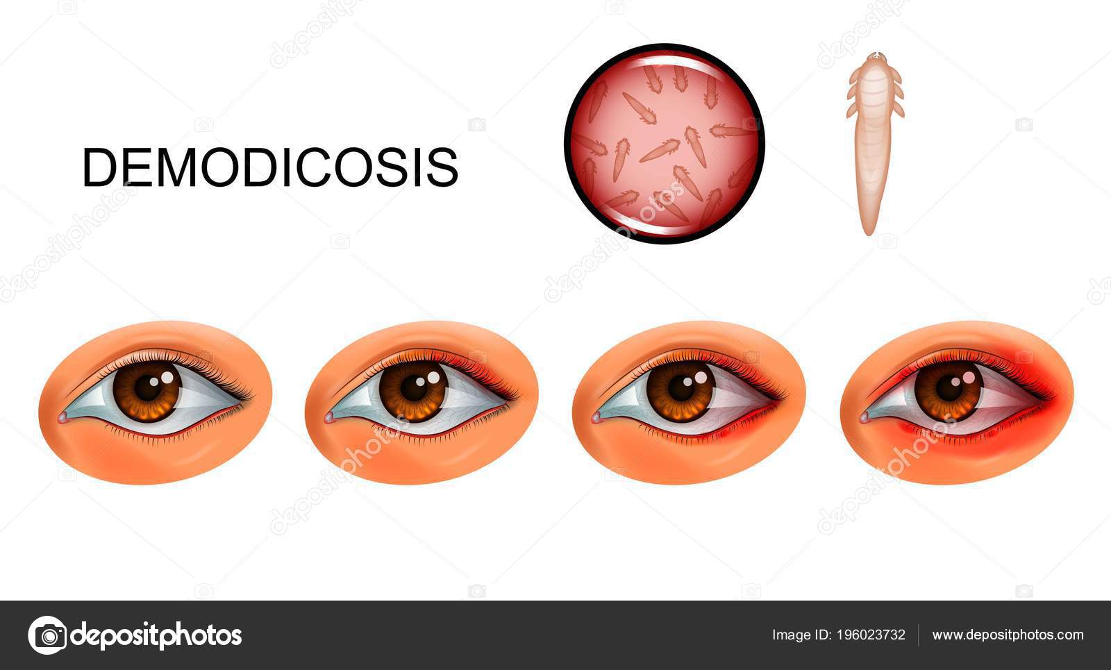 Demodecosis 的向量例证睫毛上的蜱螨图库矢量图©Artemida-psy 196023732, image size:1600x965