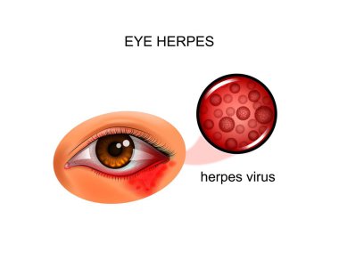 vector illustration of herpes virus of the eye clipart