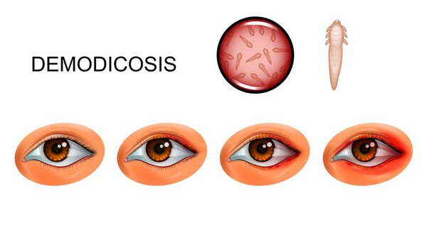 vector illustration of demodecosis. tick Demodex on eyelashes